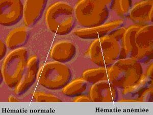 Anémie falciforme de la drépanocytose